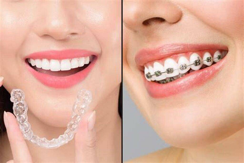 Invisalign treatment near me service at Boss Dental clinic in Coimbatore