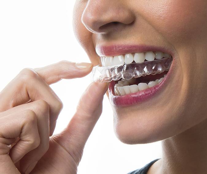 Invisalign treatment near me service at Boss Dental clinic in Coimbatore