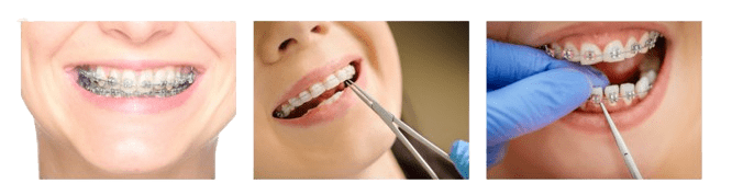 Invisalign treatment near me service at Boss Dental clinic in Coimbatore
