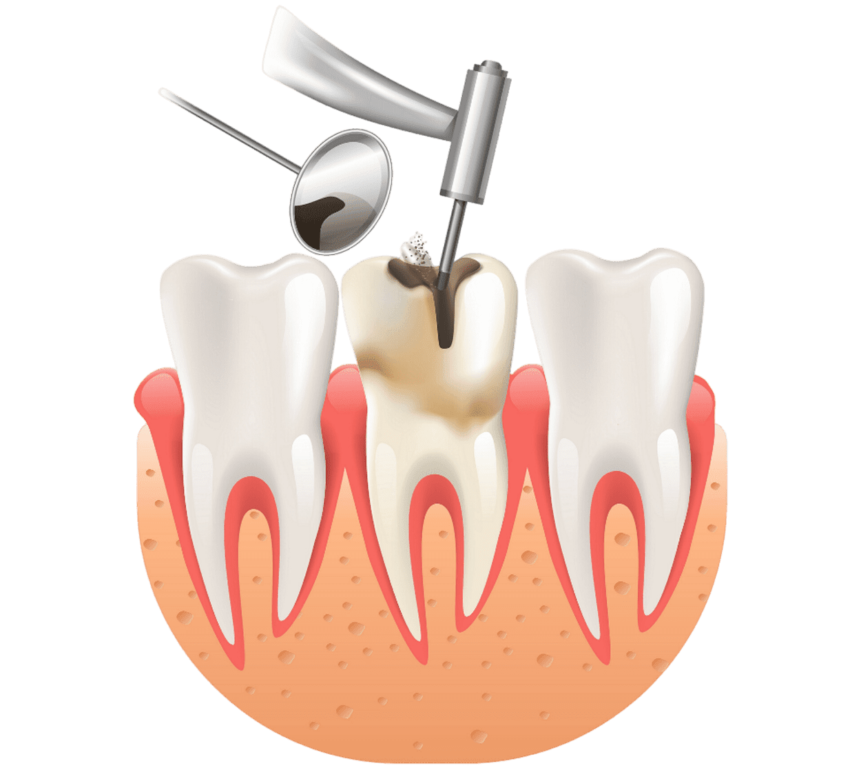 dental fillings service at Boss Dental clinic in Coimbatore