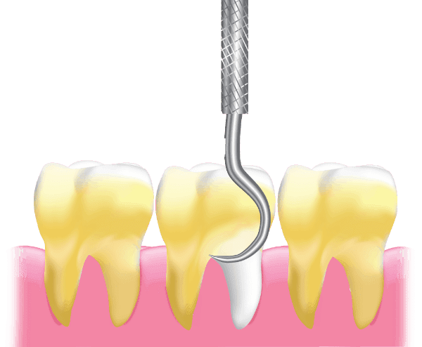 teeth cleaning Coimbatore service at Boss Dental clinic in Coimbatore