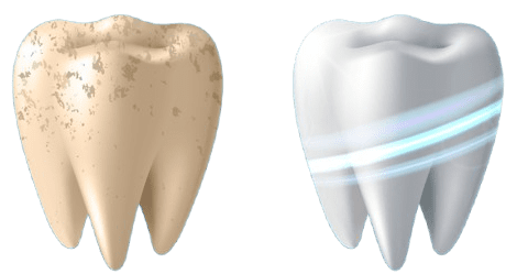 teeth cleaning Coimbatore service at Boss Dental clinic in Coimbatore